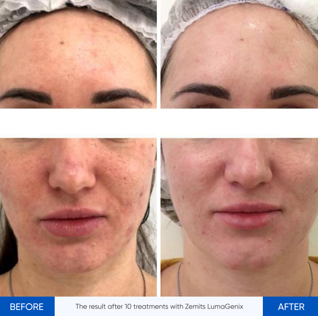 Zemits LumaGenix PDT Professionell LED-ljusterapienhet