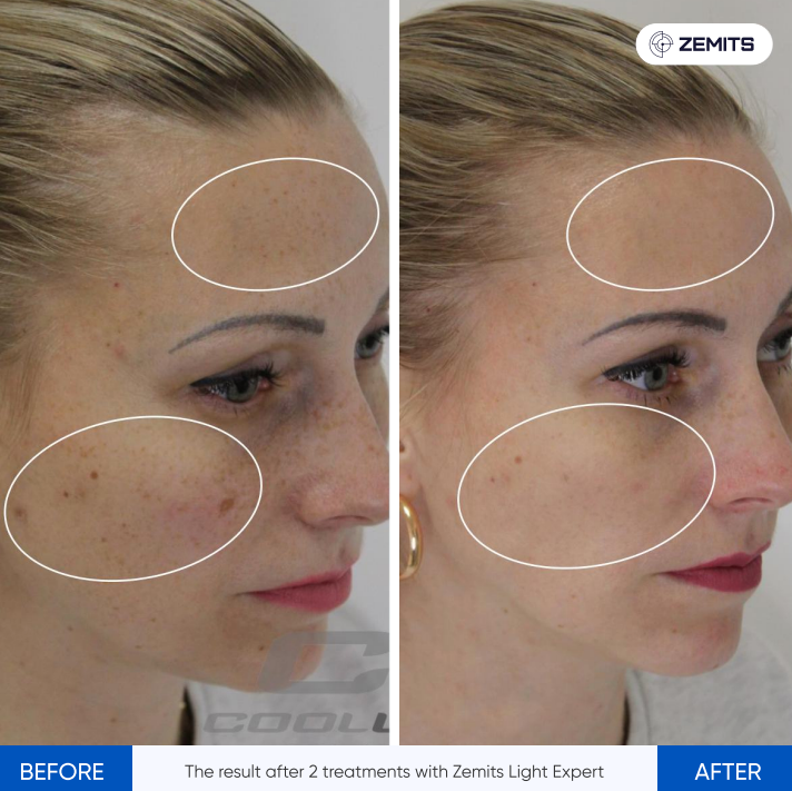 Zemits Light Expert 2.0 IPL Laser Maskin