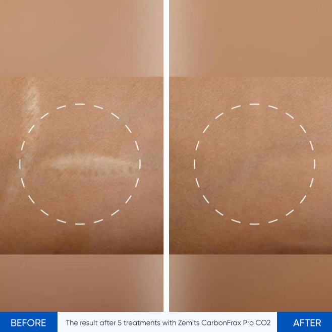 Zemits CarbonFrax Pro: CO2 Fraktionerad Laser