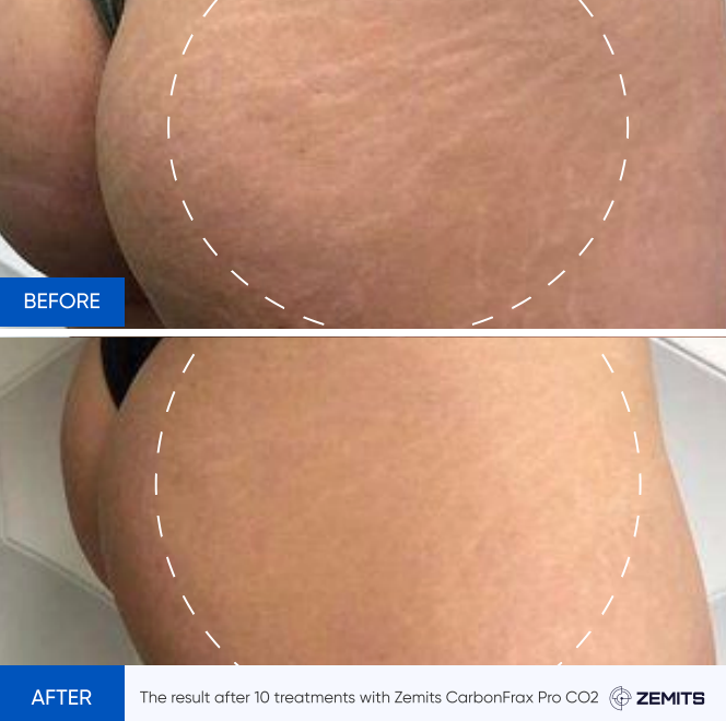 Zemits CarbonFrax Pro: CO2 Fraktionerad Laser