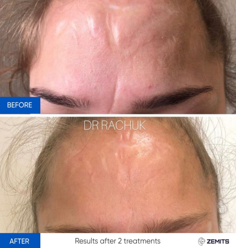 Zemits CarbonFrax Pro: CO2 Fraktionerad Laser