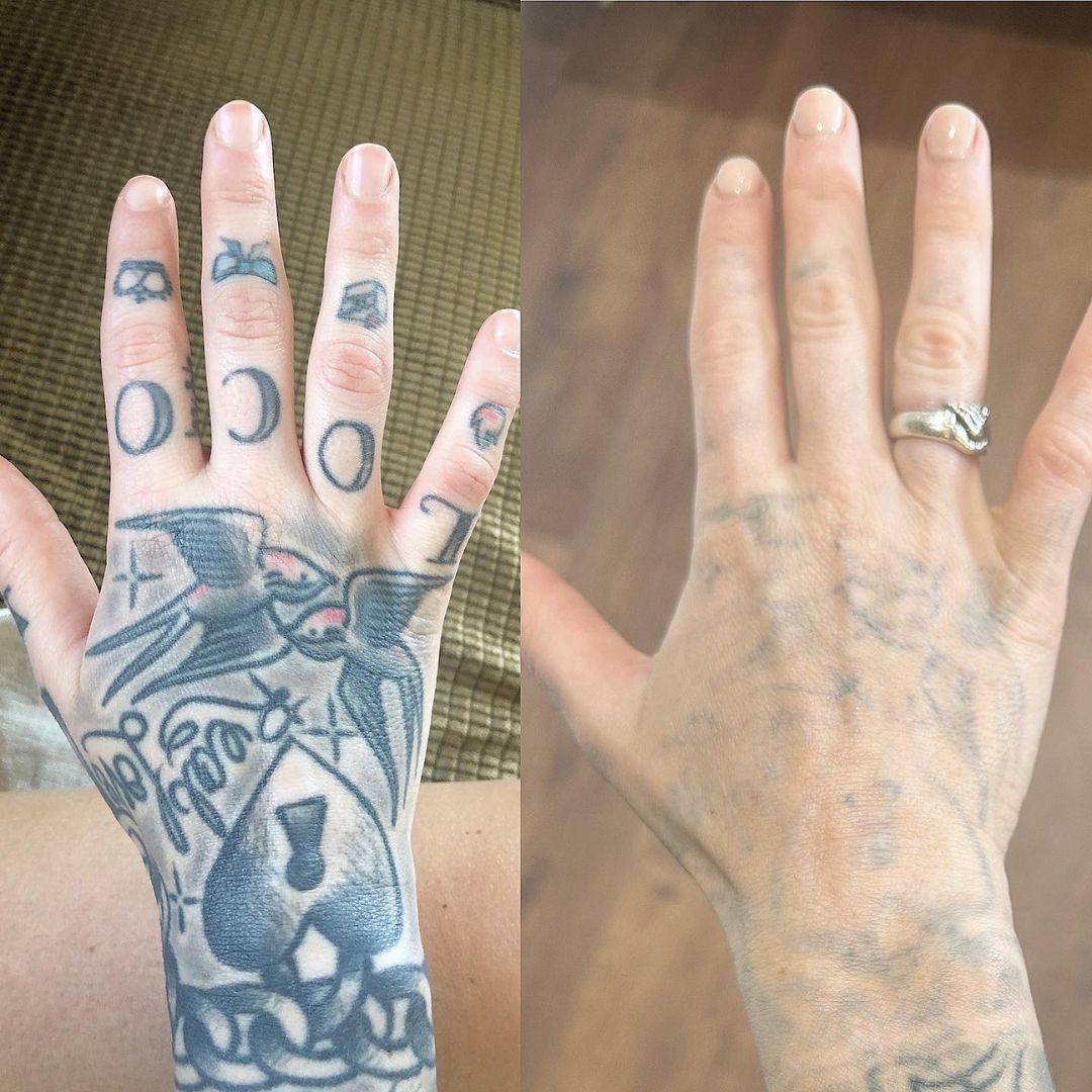 Zemits YAGenix Q-Switchad Nd:YAG Laser