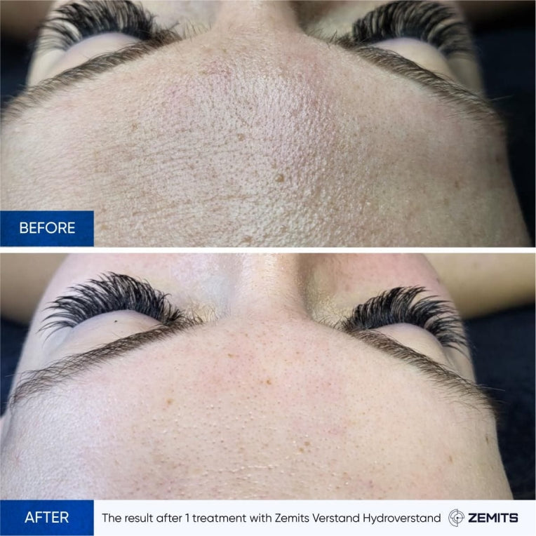 Zemits HydroVerstand PRO 7-i-1 HydroDiamond™ System