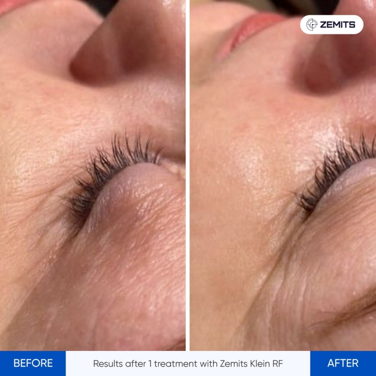 Zemits Klein RF Huduppstramningssystem