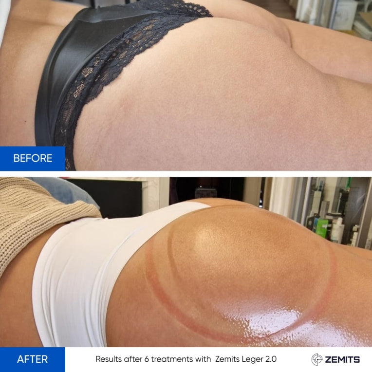 Zemits Leger 2.0 Vakuumkoppningssystem med XXL-koppar i set