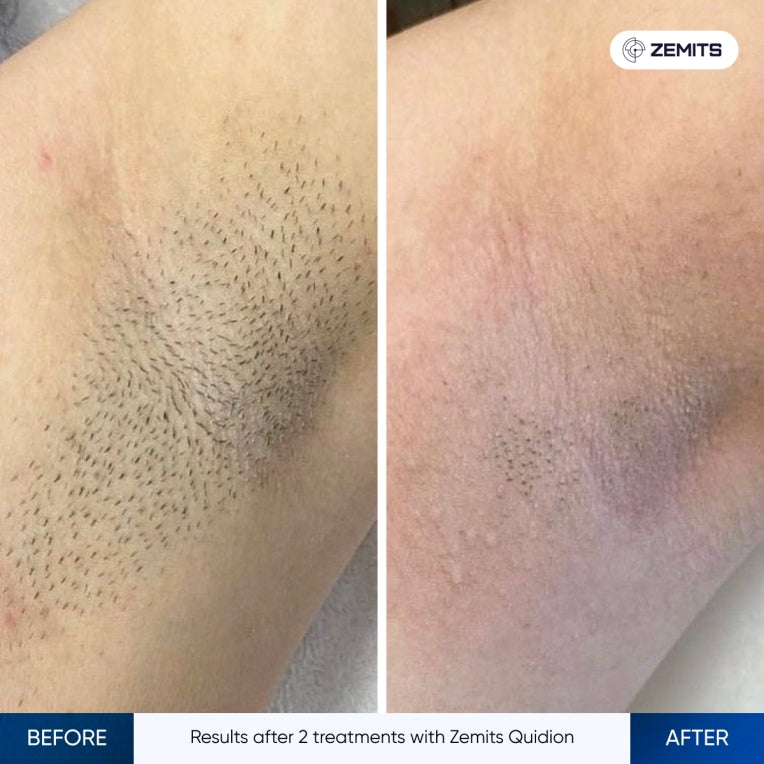 Zemits Quidion Diodlaser för hårborttagning