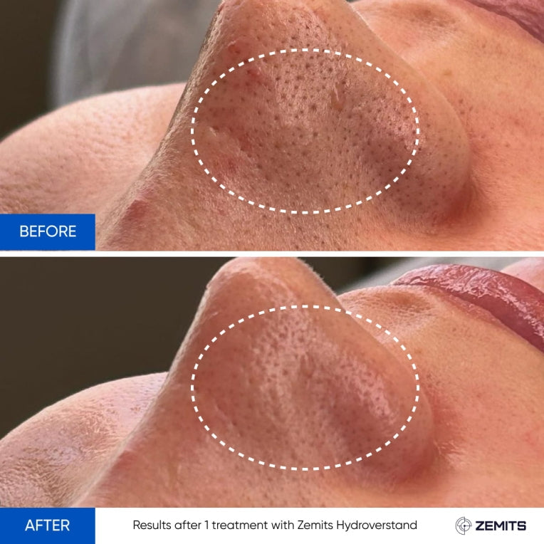 Zemits HydroVerstand PRO 7-i-1 HydroDiamond™ System