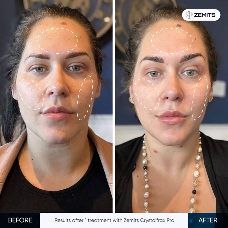 Zemits CrystalFrax PRO Icke-invasivt fraktionerat RF-system