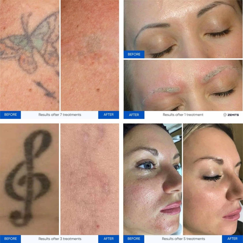 Zemits YAGenix Q-Switchad Nd:YAG Laser